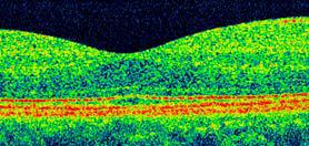 Immagine OCT spectral domain ad alta risoluzione di retina normale